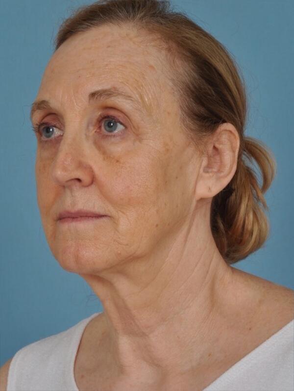 Facelift Before & After Image