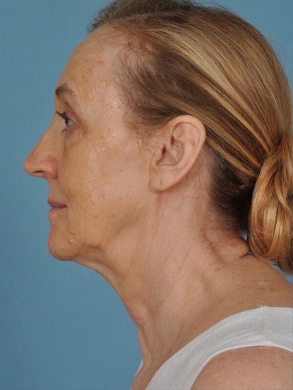 Facelift Before & After Image