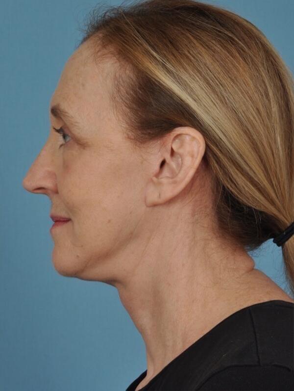 Facelift Before & After Image