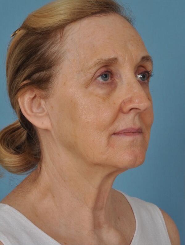 Facelift Before & After Image