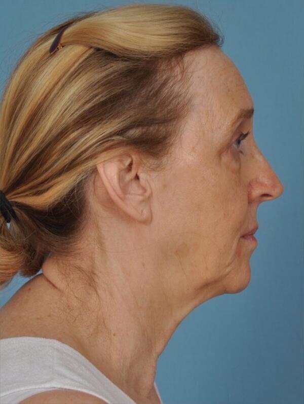 Facelift Before & After Image