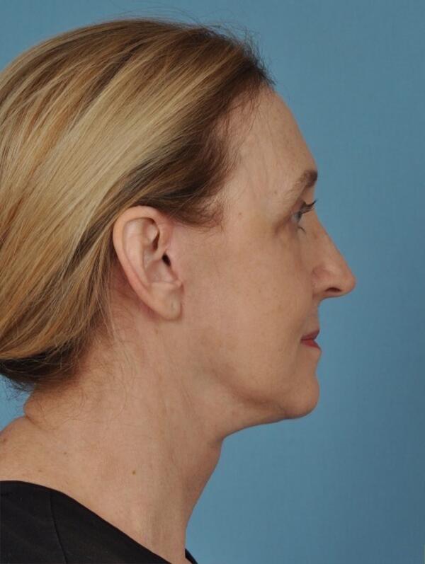 Facelift Before & After Image