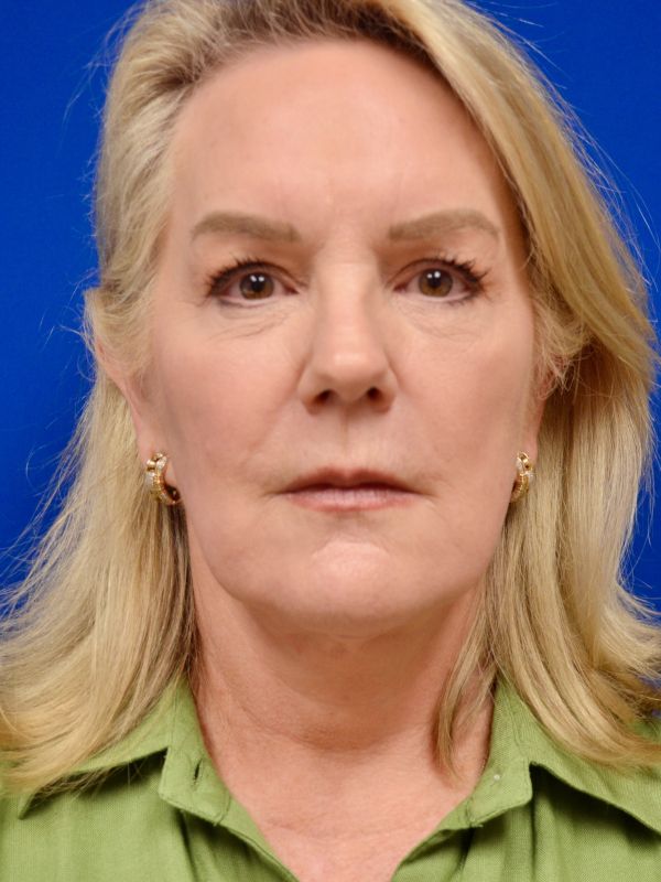 Facelift Before & After Image