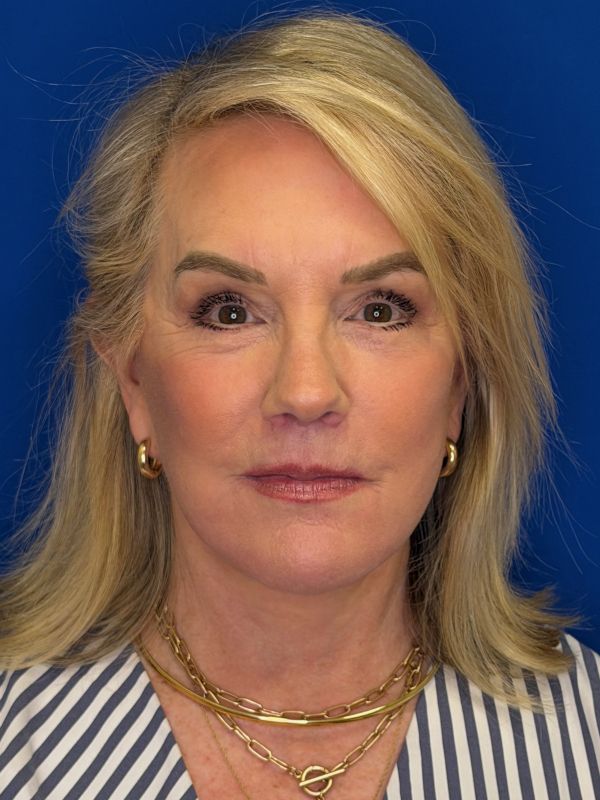 Facelift Before & After Image