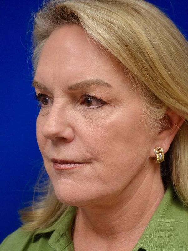Facelift Before & After Image