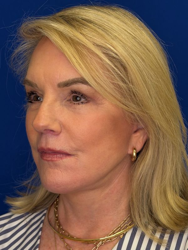 Facelift Before & After Image