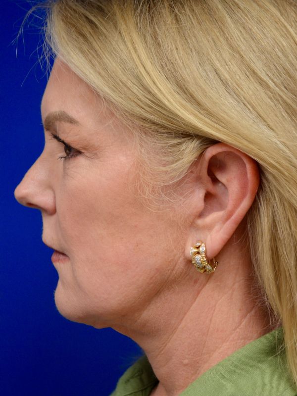 Facelift Before & After Image