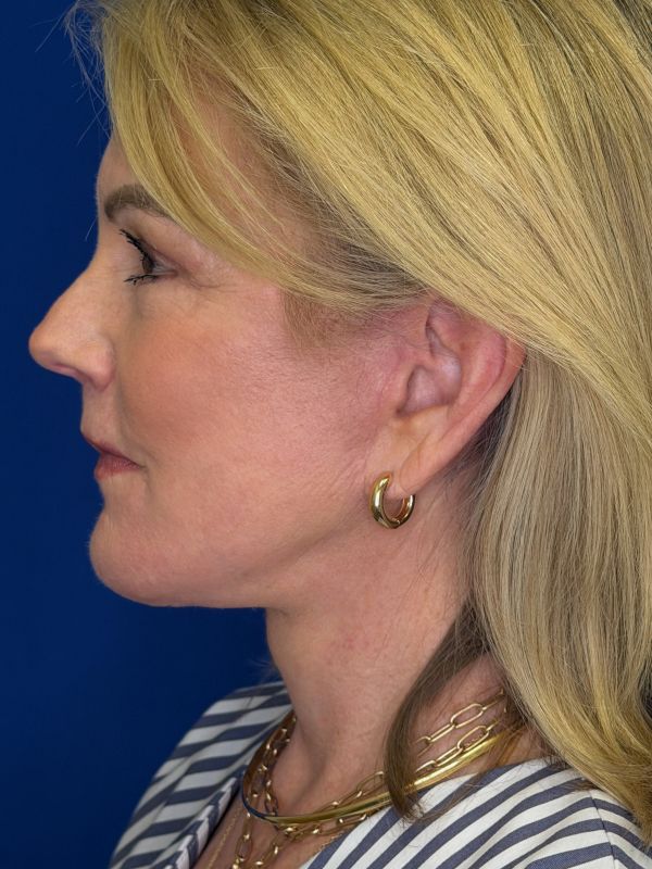 Facelift Before & After Image
