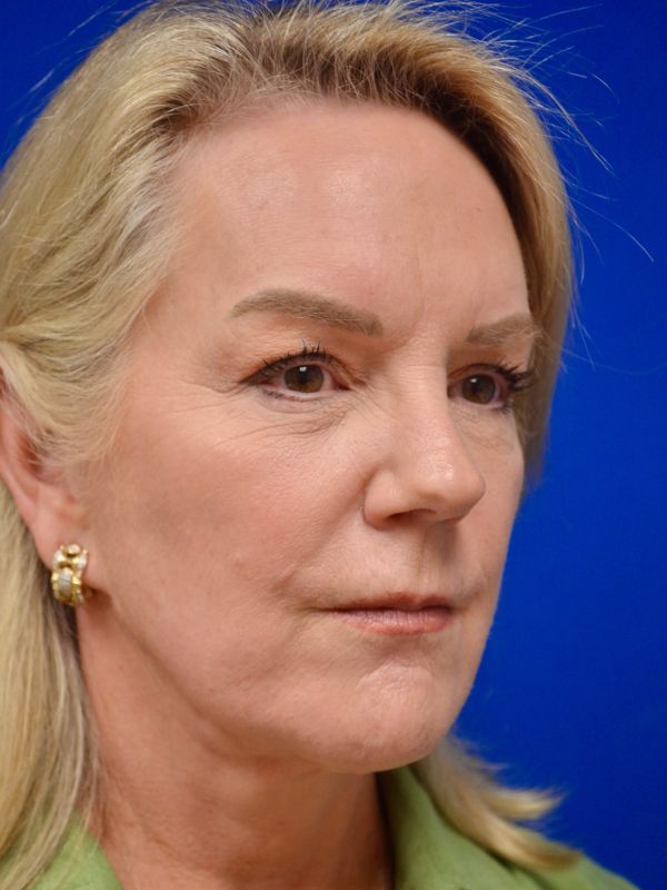 Facelift Before & After Image