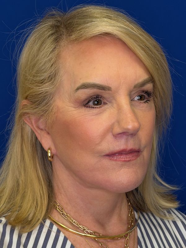 Facelift Before & After Image
