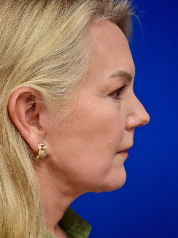 Facelift Before & After Image