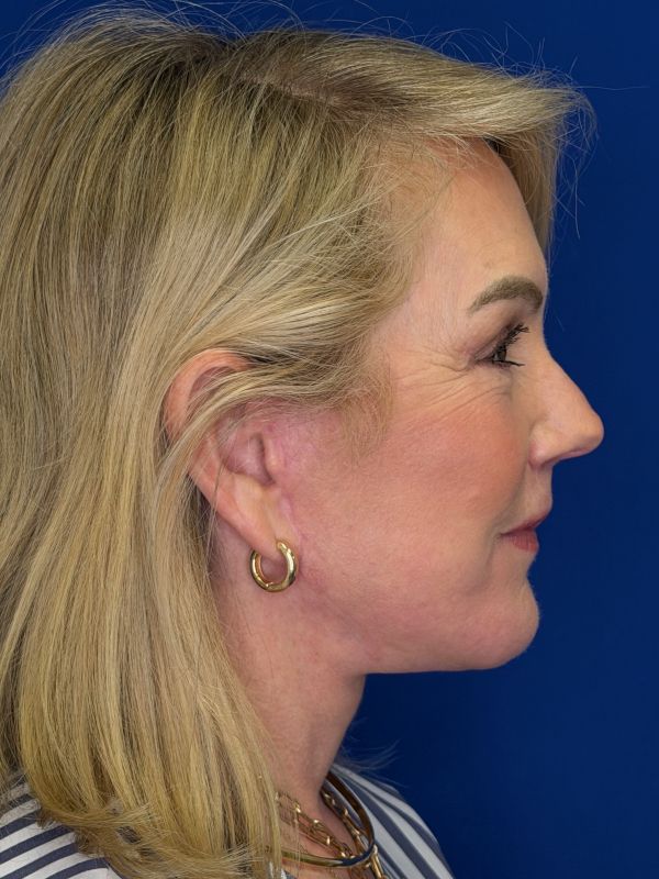 Facelift Before & After Image