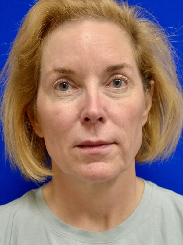 Facelift Before & After Image