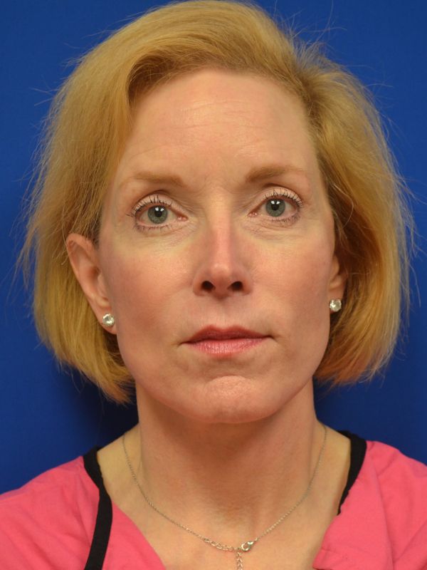 Facelift Before & After Image