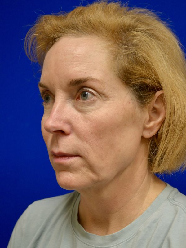 Facelift Before & After Image