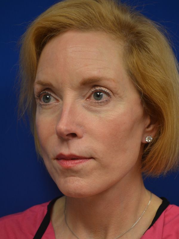 Facelift Before & After Image