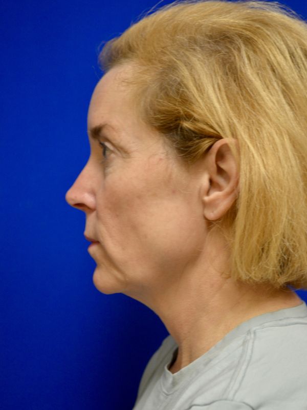Facelift Before & After Image