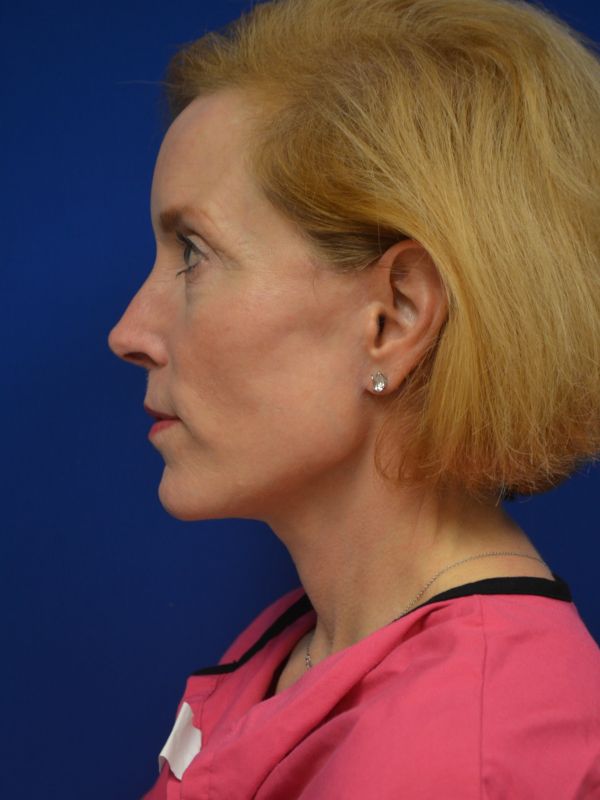 Facelift Before & After Image