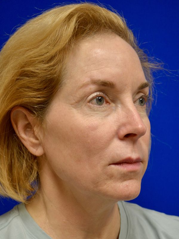 Facelift Before & After Image