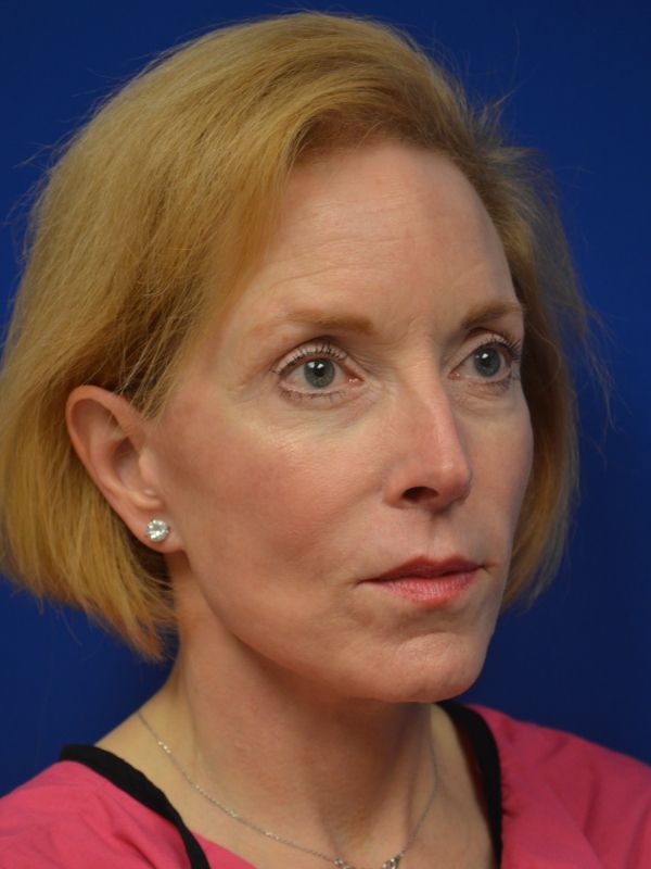 Facelift Before & After Image