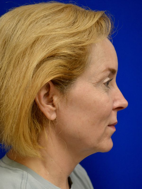 Facelift Before & After Image