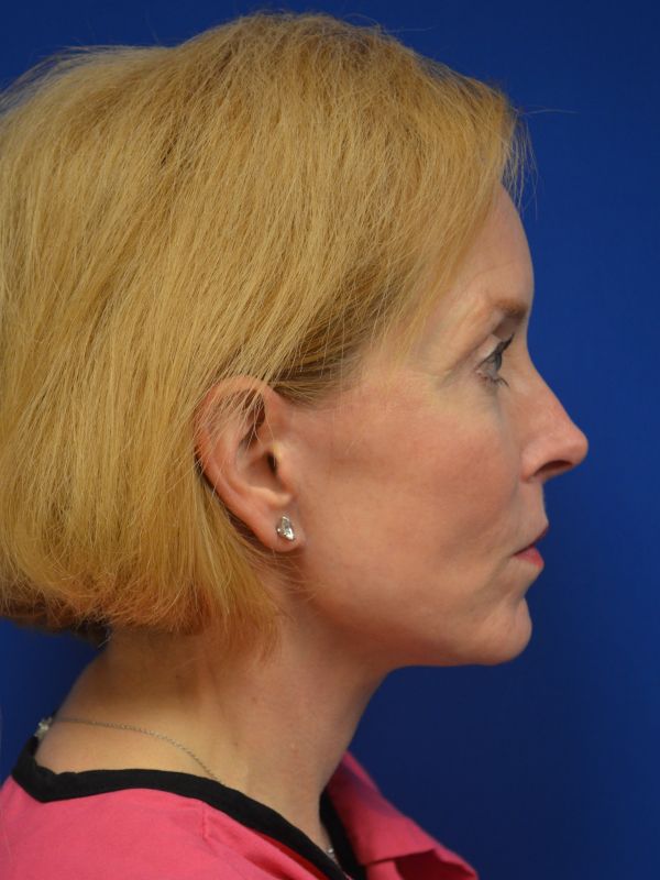 Facelift Before & After Image