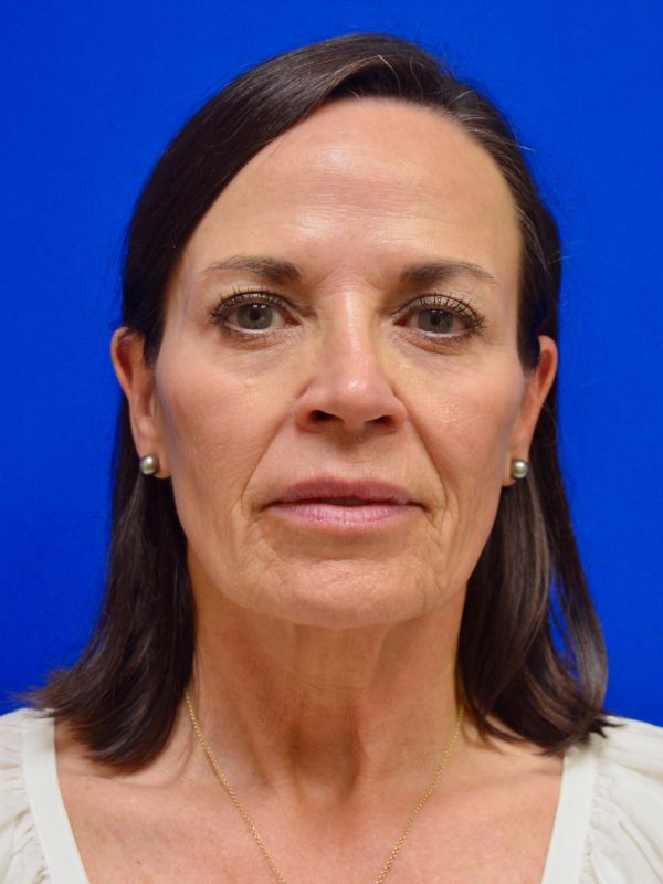 Facelift Before & After Image