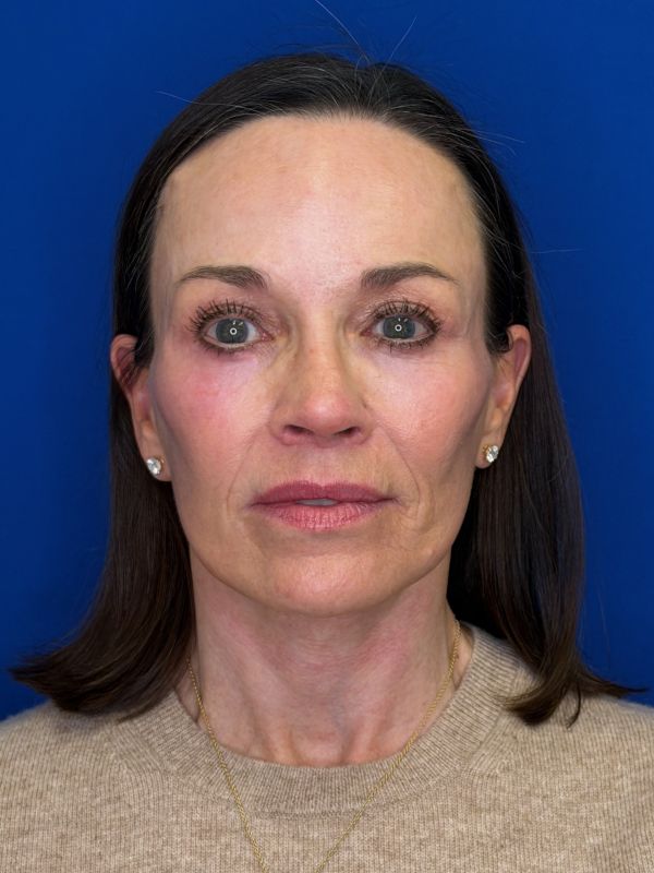 Facelift Before & After Image