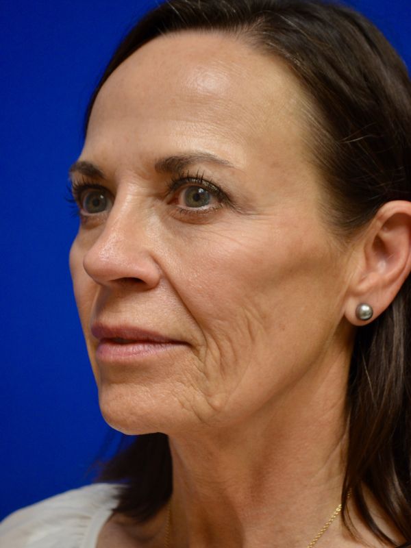 Facelift Before & After Image