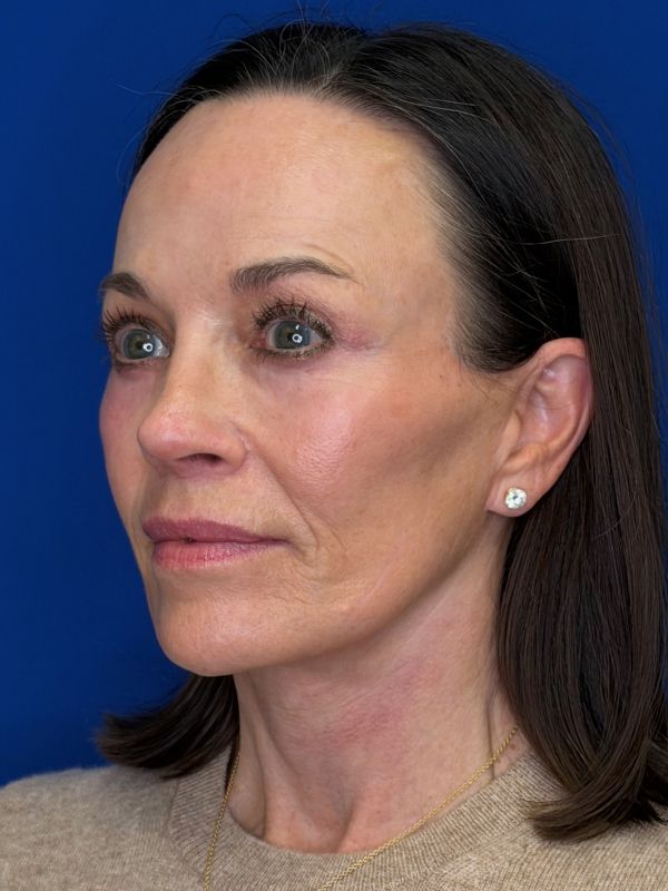 Facelift Before & After Image