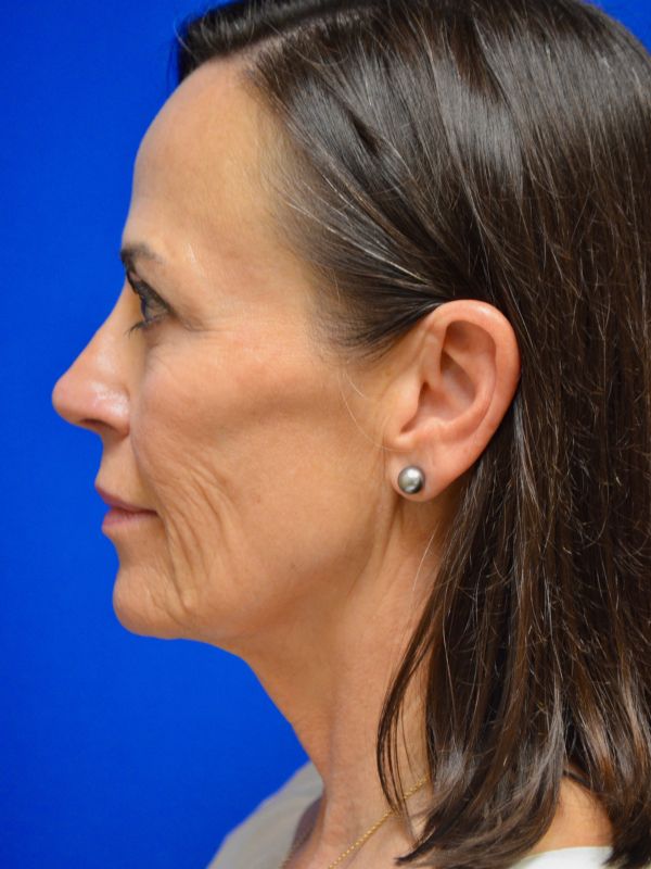 Facelift Before & After Image