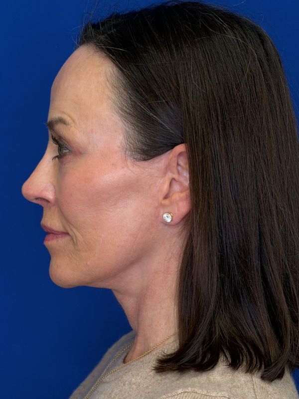 Facelift Before & After Image