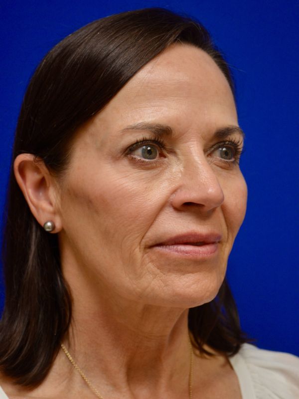 Facelift Before & After Image