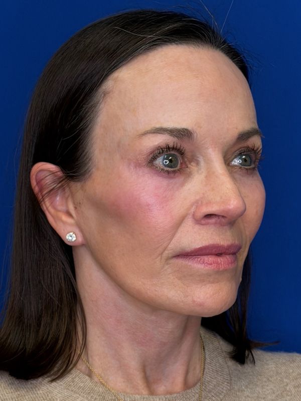 Facelift Before & After Image
