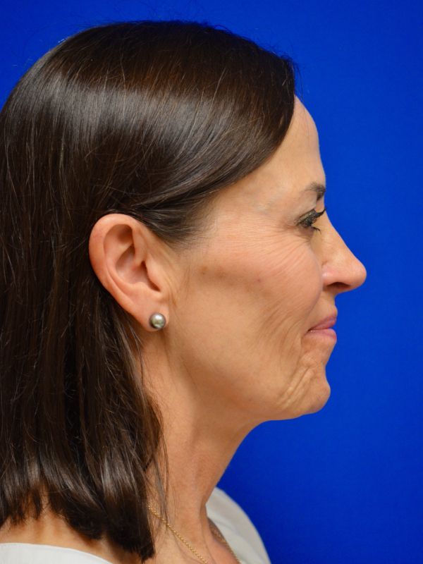 Facelift Before & After Image