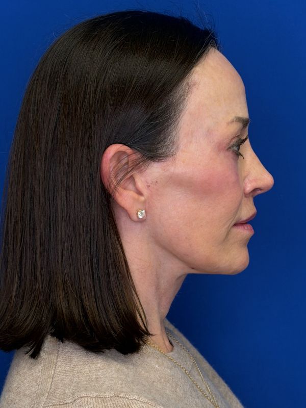 Facelift Before & After Image