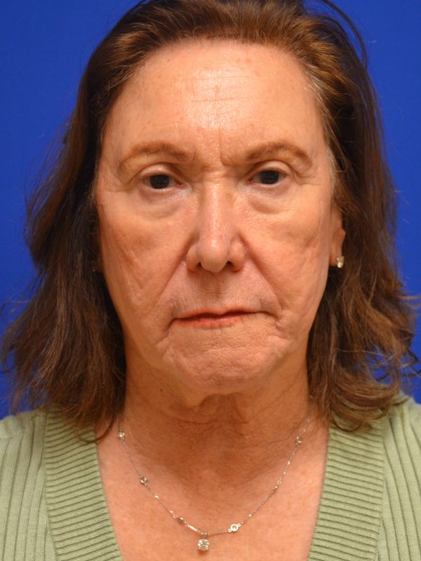Facelift Before & After Image