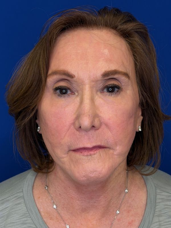 Facelift Before & After Image