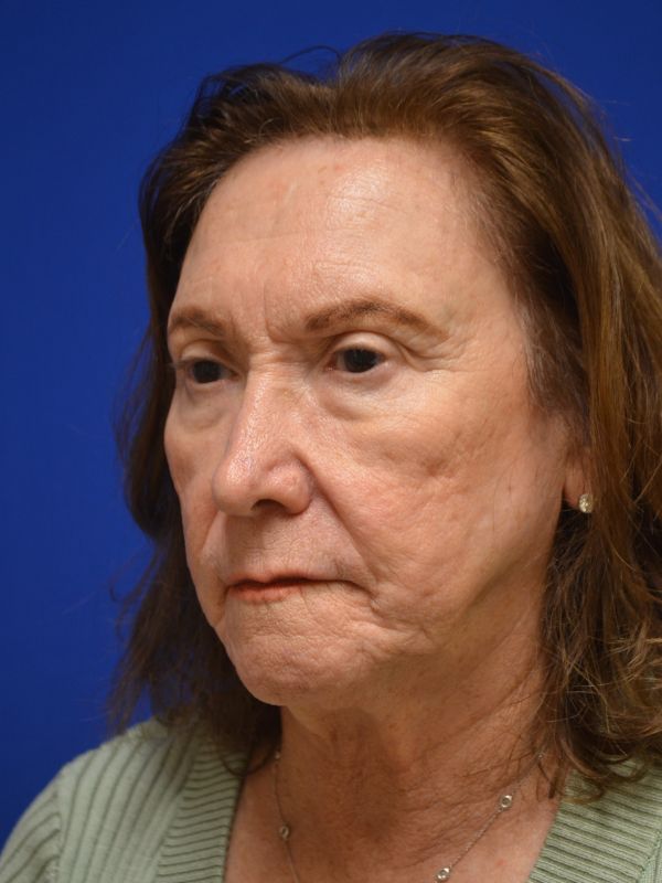 Facelift Before & After Image