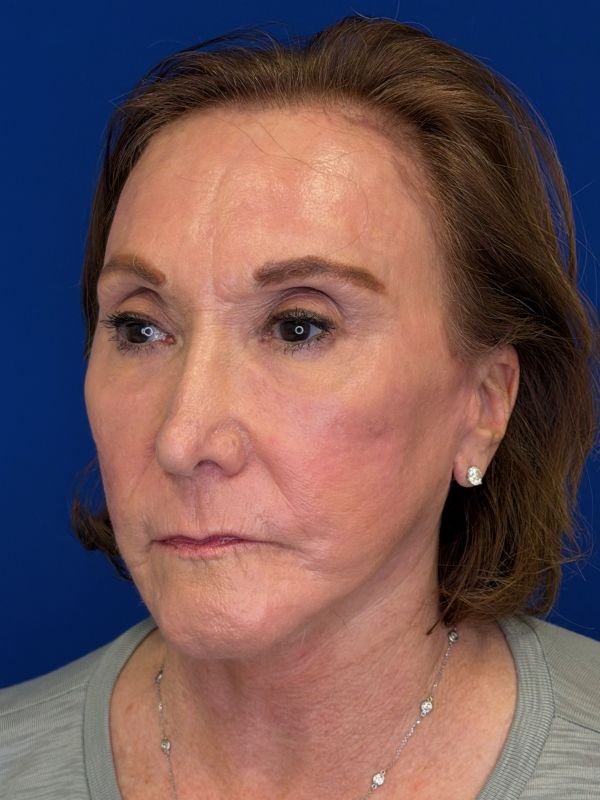 Facelift Before & After Image