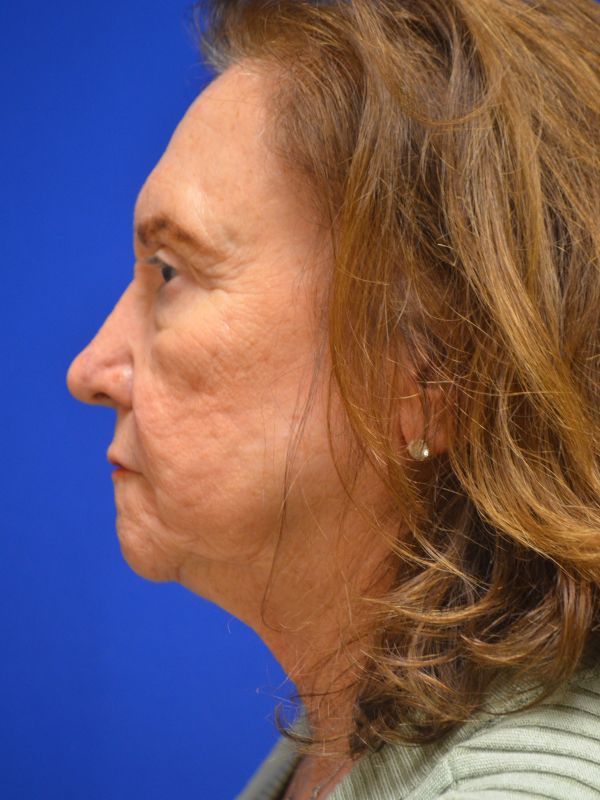 Facelift Before & After Image