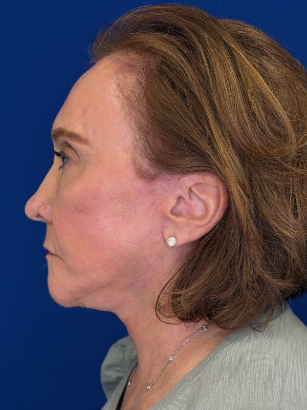 Facelift Before & After Image