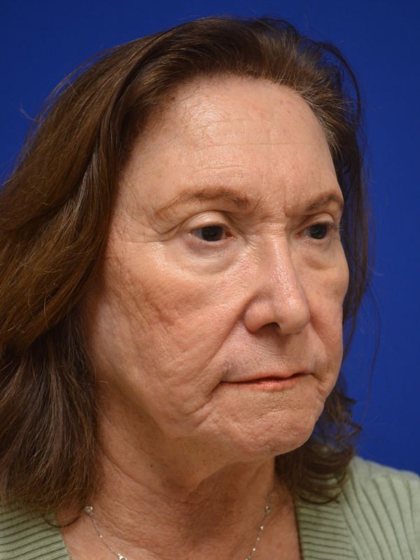 Facelift Before & After Image