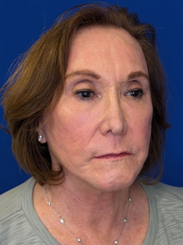 Facelift Before & After Image