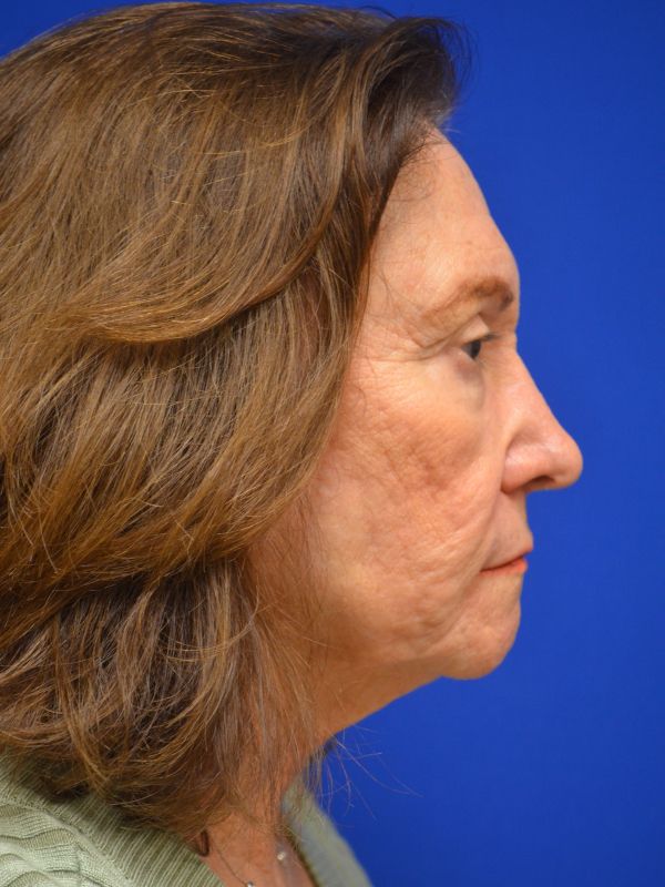 Facelift Before & After Image
