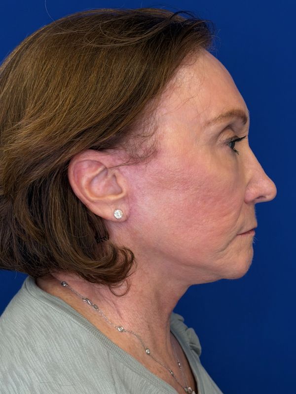 Facelift Before & After Image