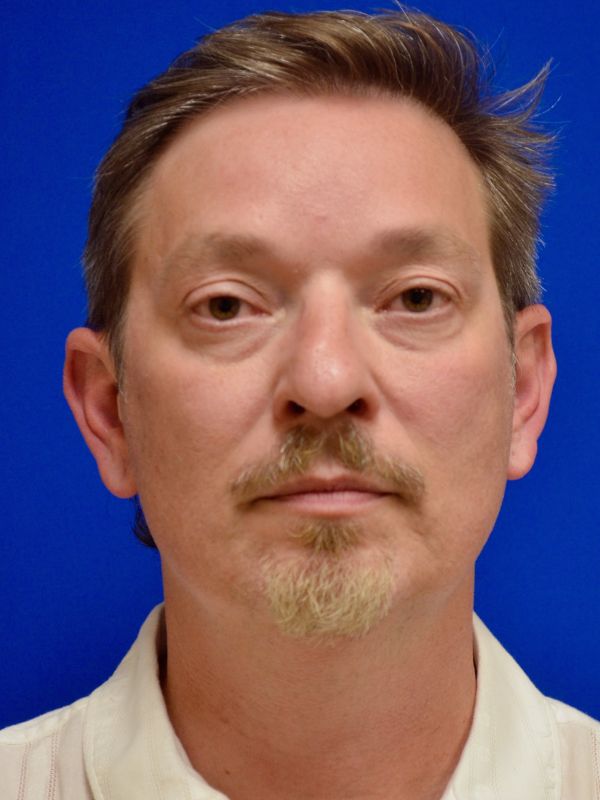 Facelift Before & After Image