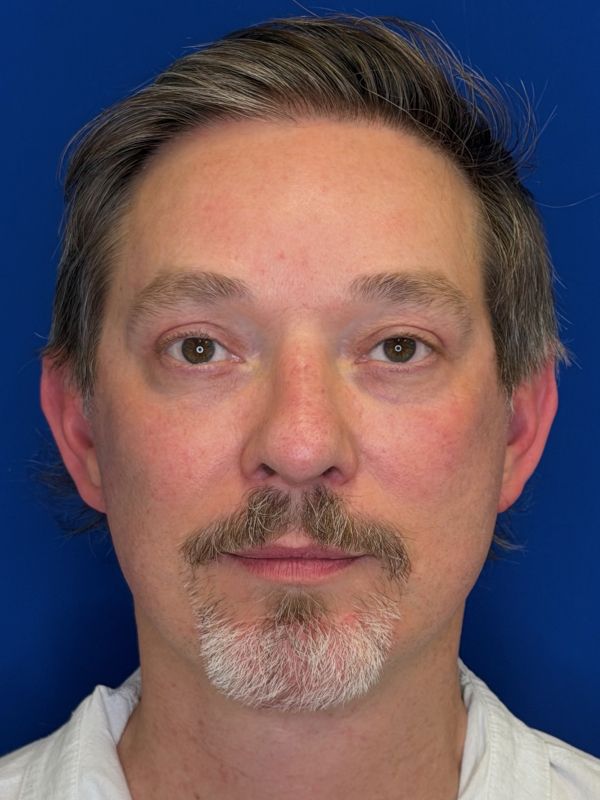 Facelift Before & After Image