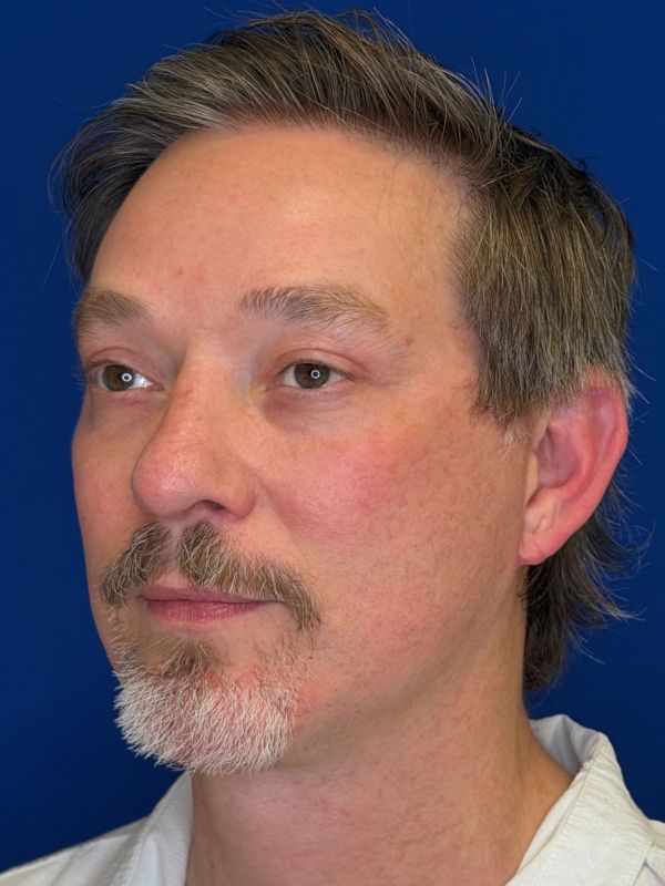 Facelift Before & After Image