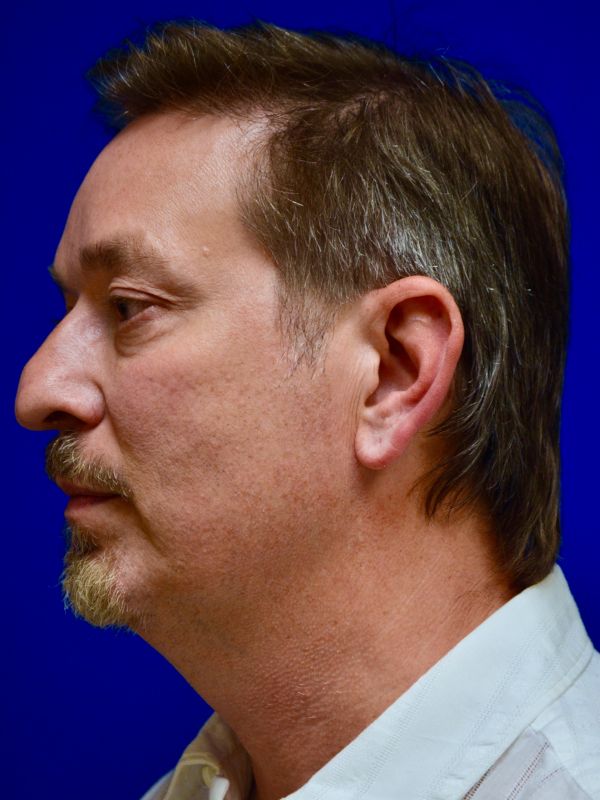 Facelift Before & After Image